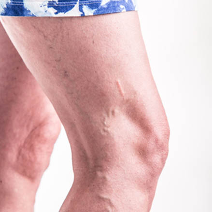 varices jambes homme