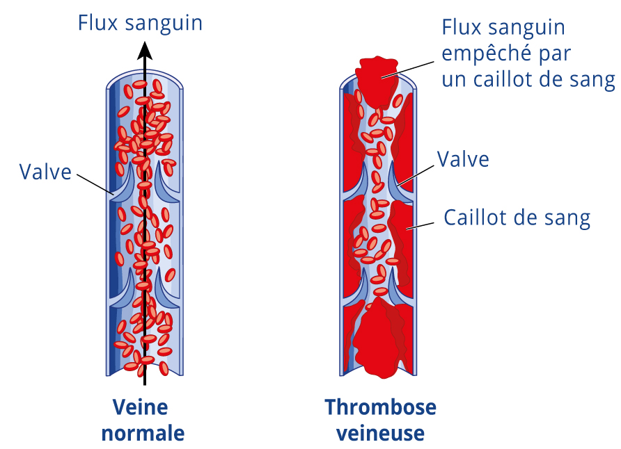 phlebite thrombose veineuse