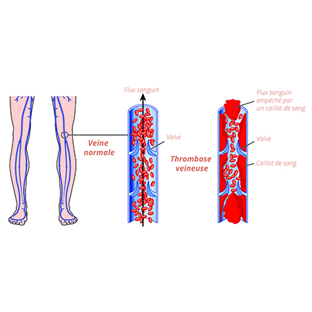 schema-phlebite-thrombose-veineuse