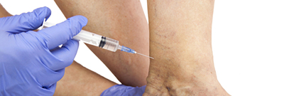 sclerotherapie-varices-des-jambes