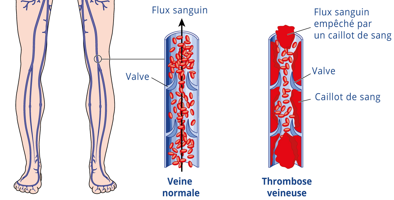 thrombose veineuse profonde (phlébite profonde)