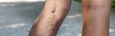 varices-phlebite