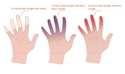 syndrome_raynaud-01