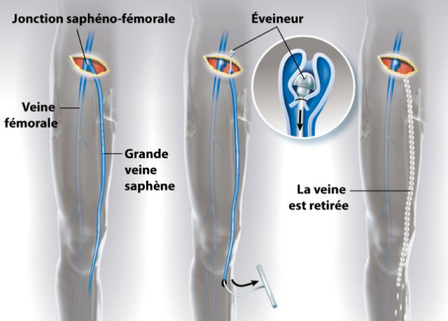 chirurgie-stripping