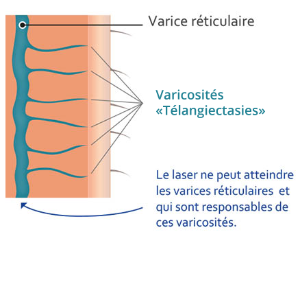 schema-laser-phlebologie-2