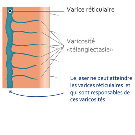 schema-laser-phlebologie