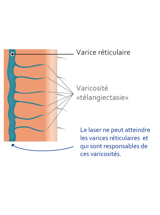 schéma-pour-laser