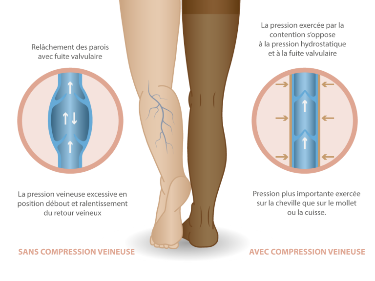 La contention veineuse I Dr. Kahina Betroune