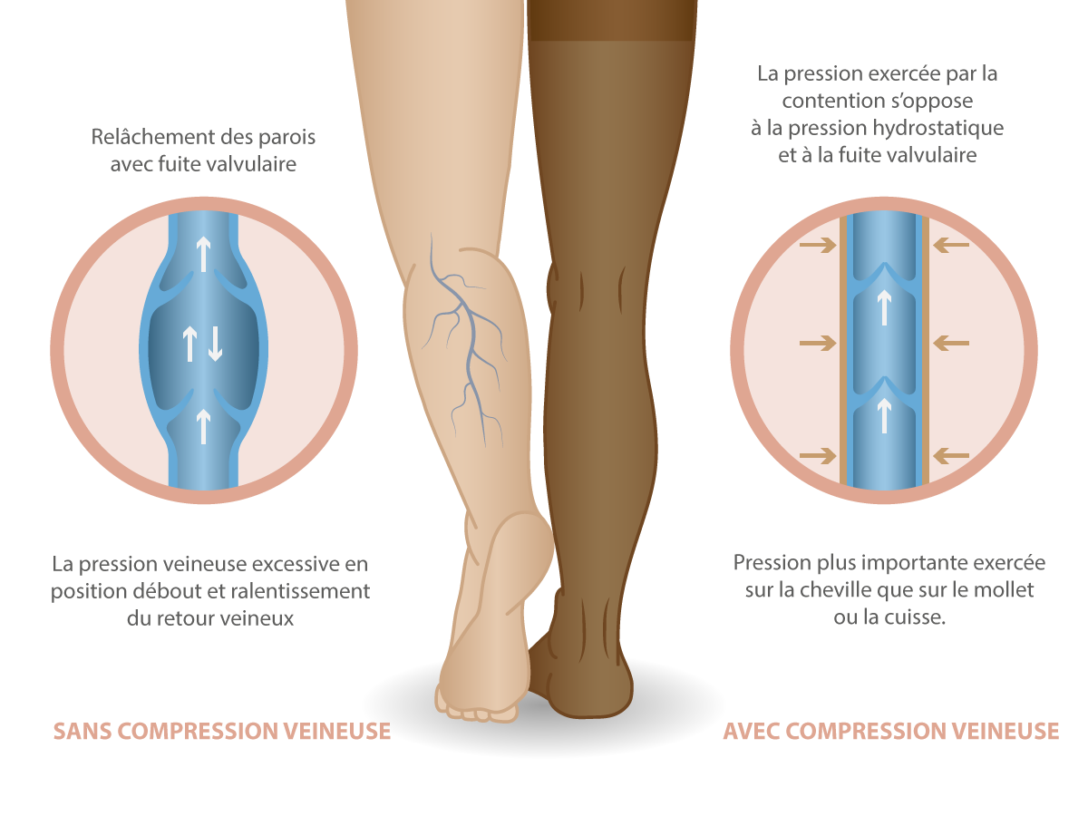 Bas - Collants de compression - Contention - Santé