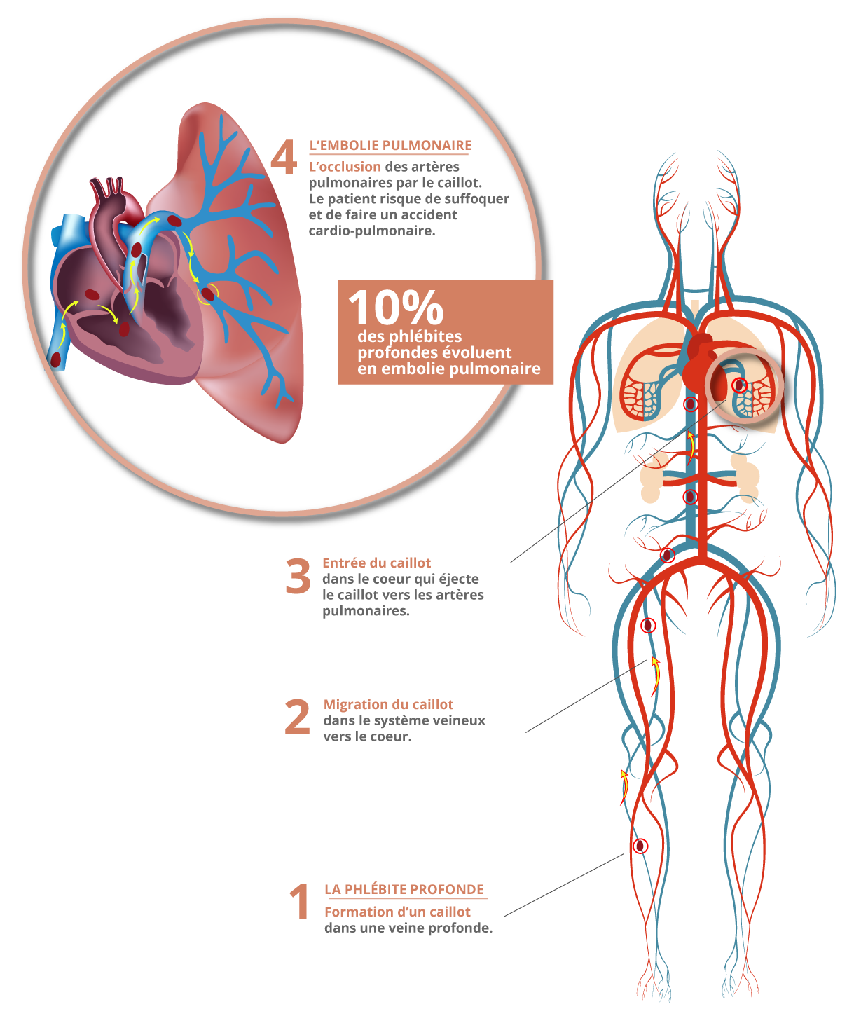 illustration-phlebite-embolie-pulmonaire