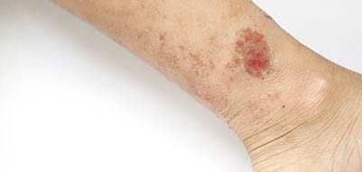 eczema-variqueux