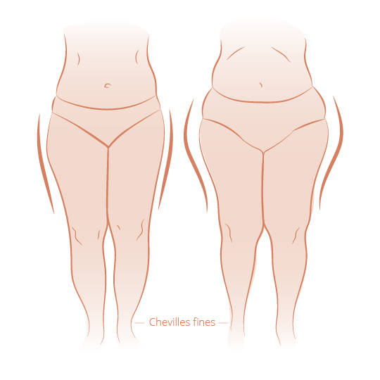 lipedema-01