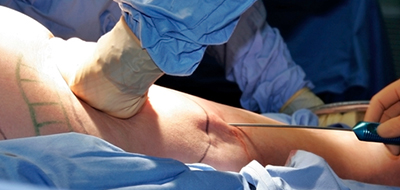 liposuccion