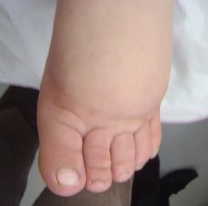 oedeme veino lymphatique